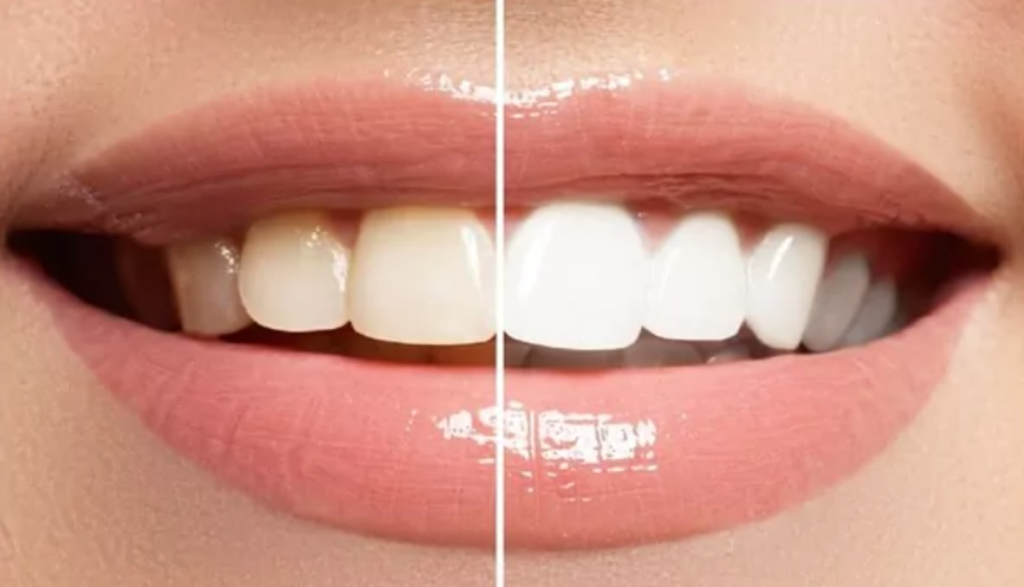 blanqueamiento dental